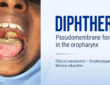 Diphtheria Outbreak Hits FCT
