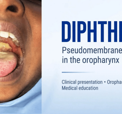 Diphtheria Outbreak Hits FCT