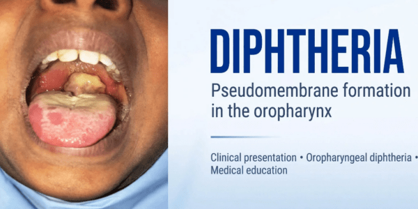 Diphtheria Outbreak Hits FCT