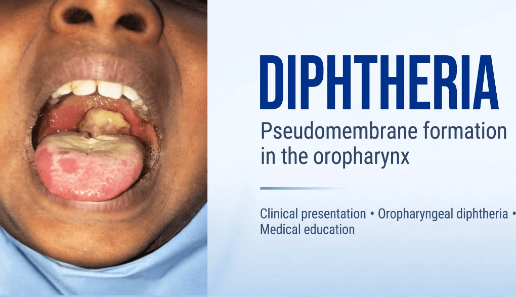 Diphtheria Outbreak Hits FCT